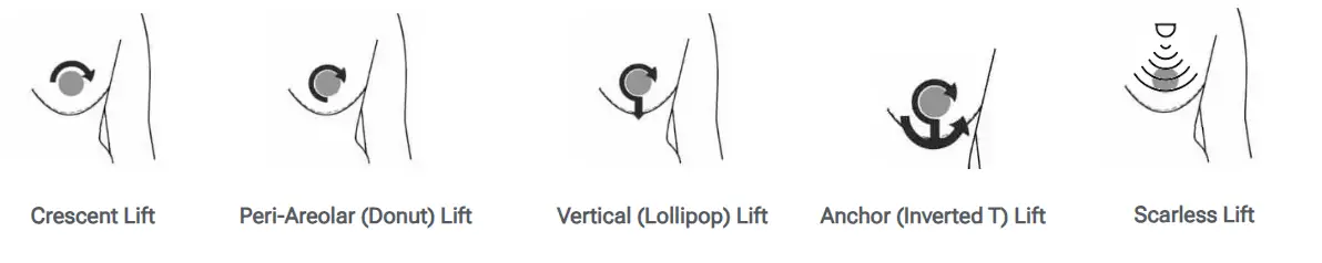 Brest Lift Techniques