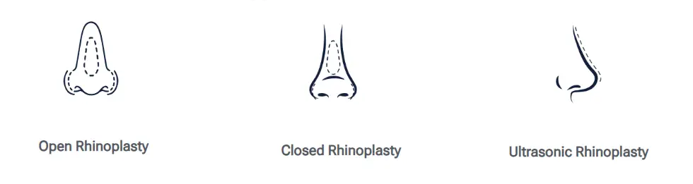 Rhinoplasty Techniques