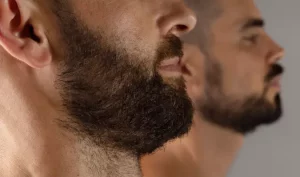 beard transplant in Iran