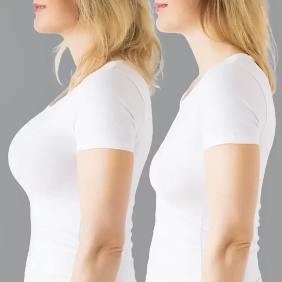 breast lift in Iran before after photos