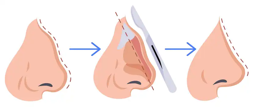 rhinoplasty in Iran procedure details