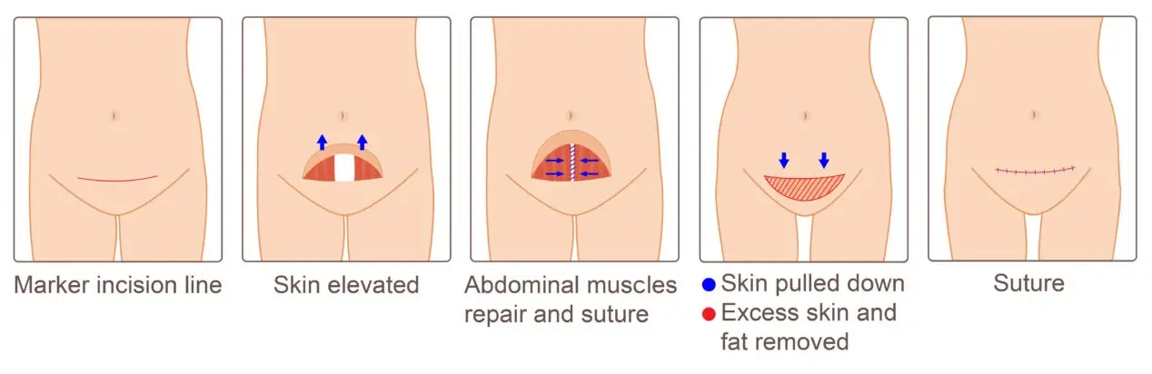 tummy tuck in Iran procedure details